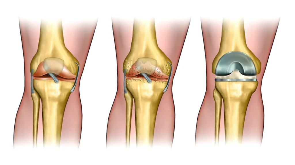 Ostex - sito ufficiale - composizione - prezzo - Italia - opinioni - recensioni - in farmacia