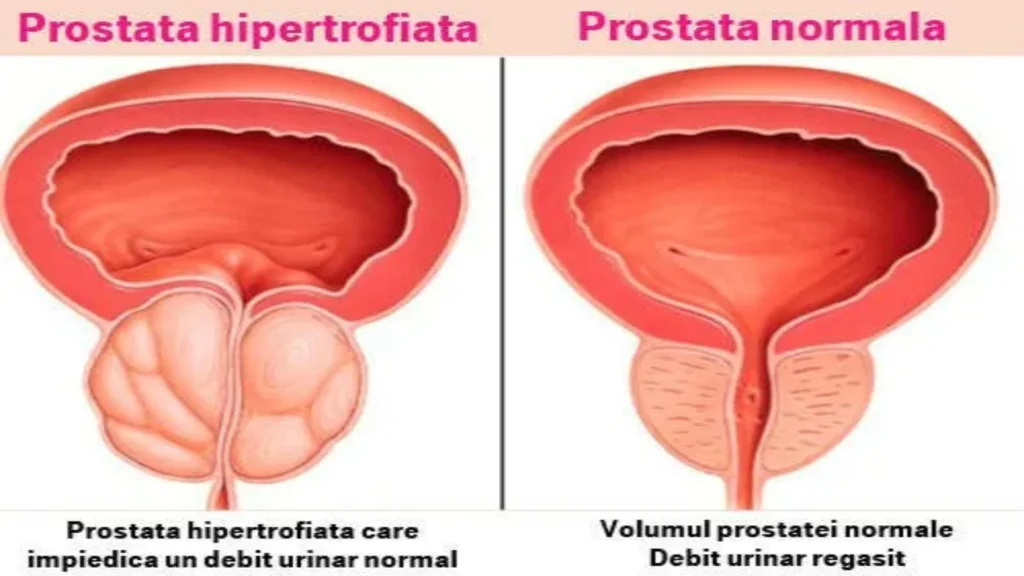 Prostalis skusenosti - ako pouzivat - ako to funguje - prísady - účinky - zloženie - ingrediencie - dávkovanie - čo to je