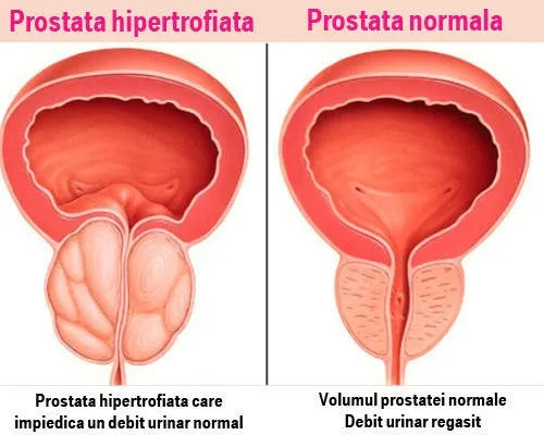 picture: Prostamid - farmaci, zbritje, ku të blej, faqja zyrtare